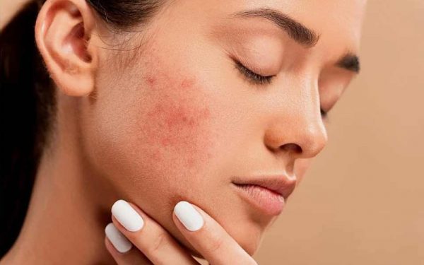 What To Look For In Acne Treatment Products For Teens